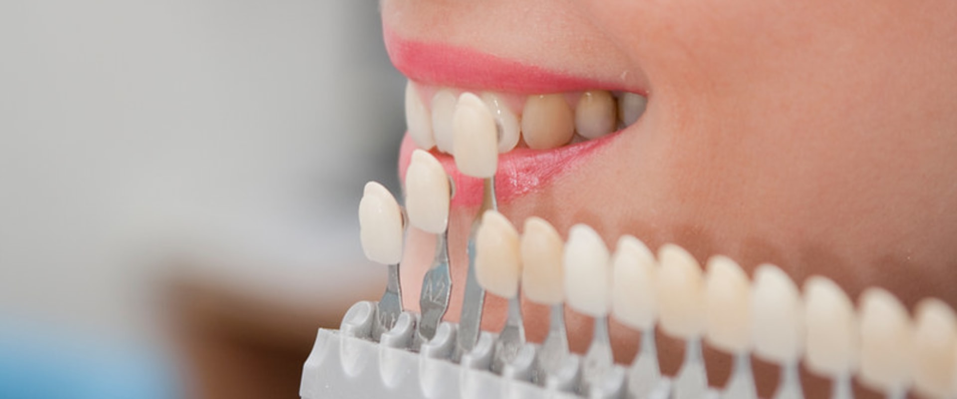 The Beauty Of Dental Veneers In Stockton: Enhance Your Smile