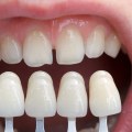 Smile Bright In Claycomo: The Power Of Dental Veneers