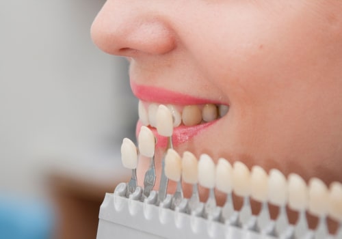 The Beauty Of Dental Veneers In Stockton: Enhance Your Smile